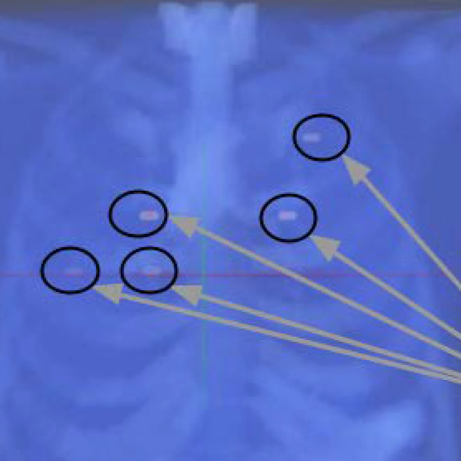 Spatio-Temporal Positron Emission Tomography Reconstruction with Attenuation and Motion Correction